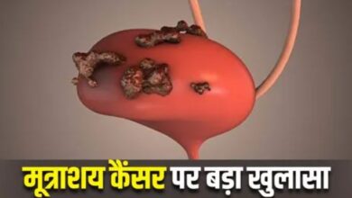 Photo of सर्जरी के बाद रेडिएशन थेरेपी से आधा हो जाता है Bladder Cancer का खतरा